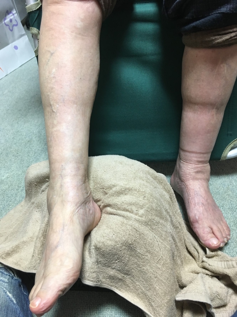 右足の施術後の写真