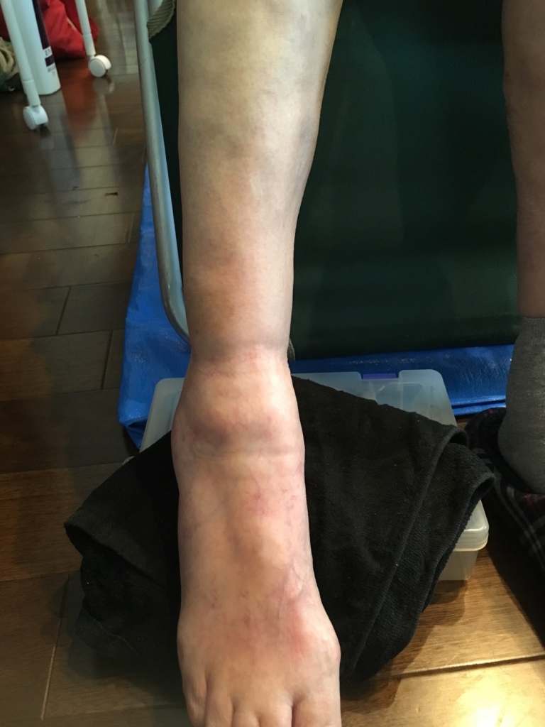 右足を施術後の写真